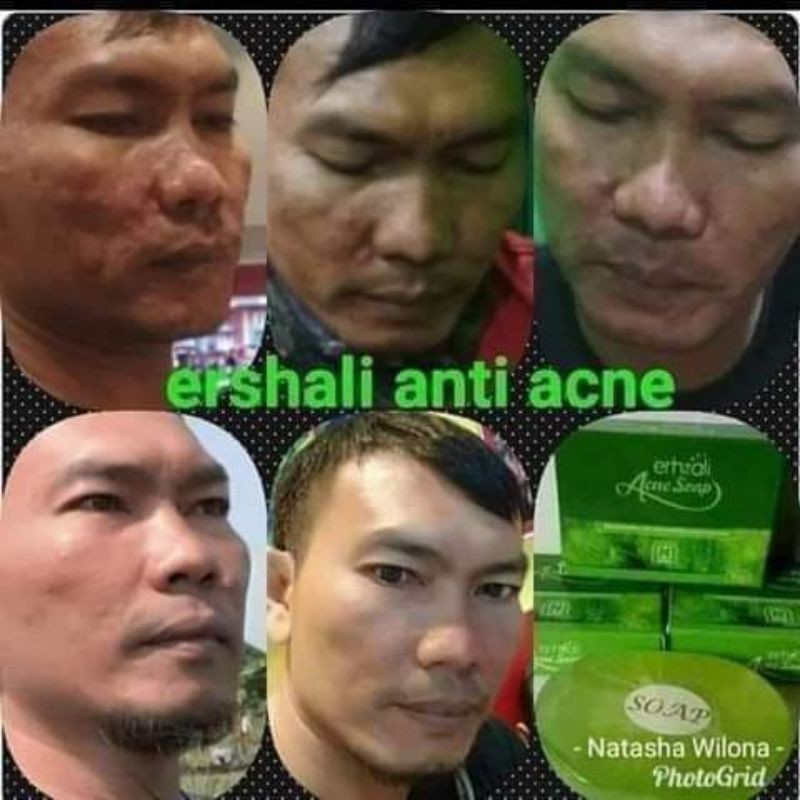 ershali acne