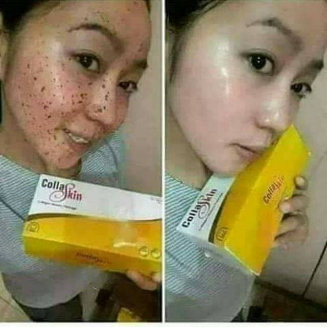 Collaskin nasa