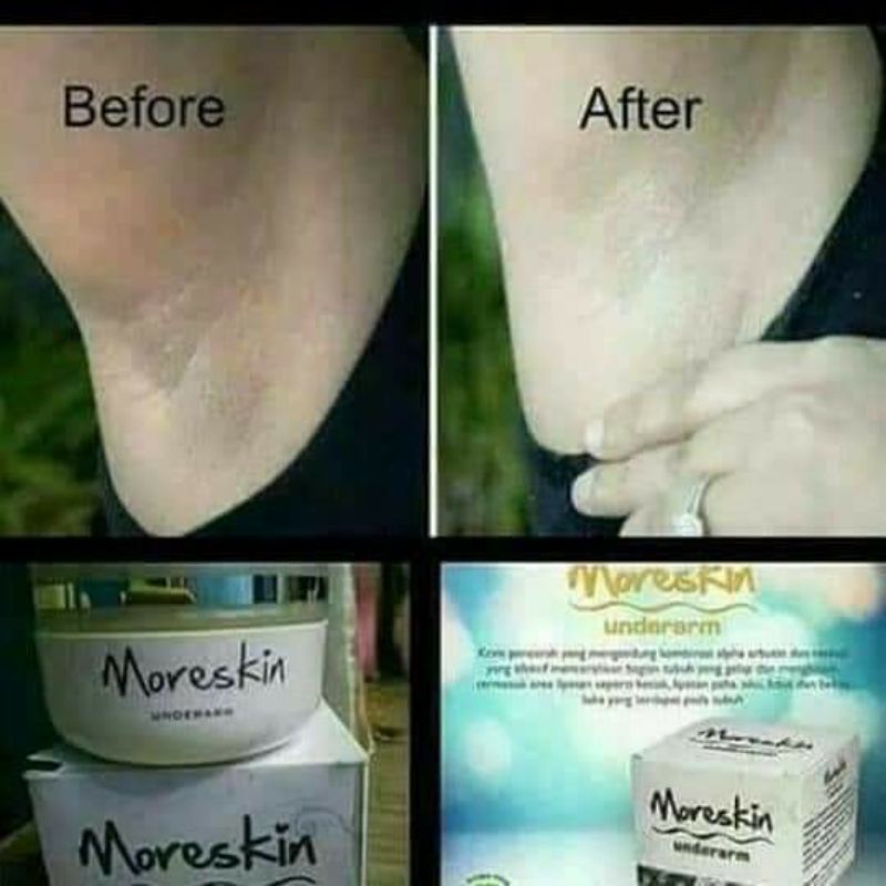 MoreskinUnderarm