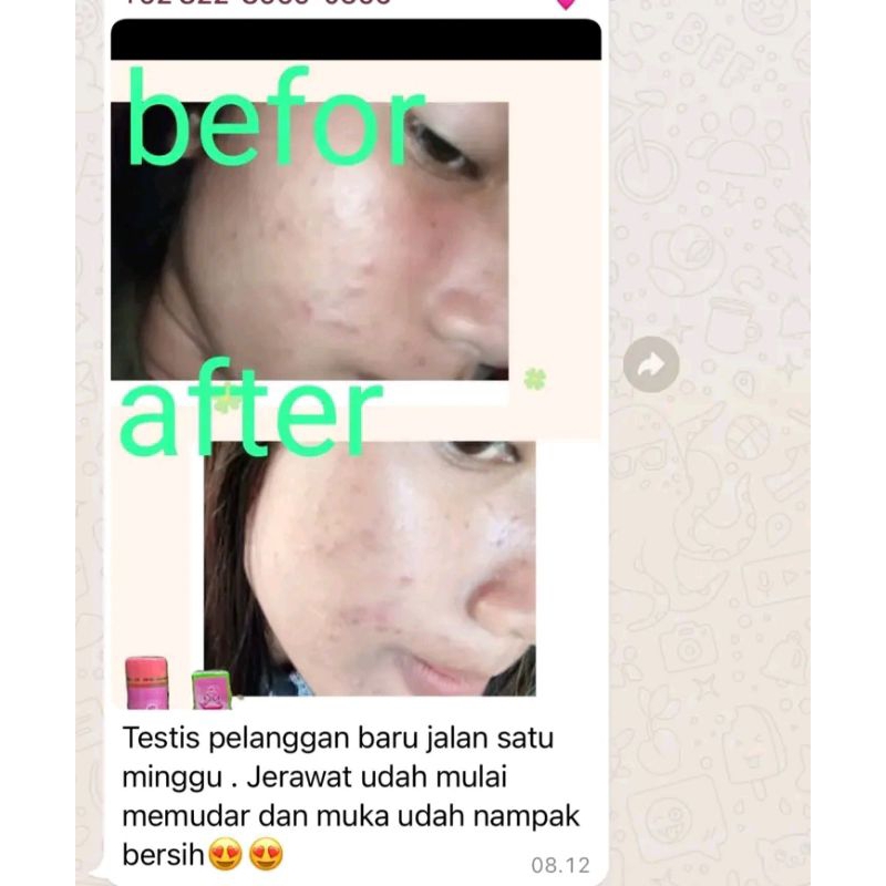 Cream Wsp Glow Acne