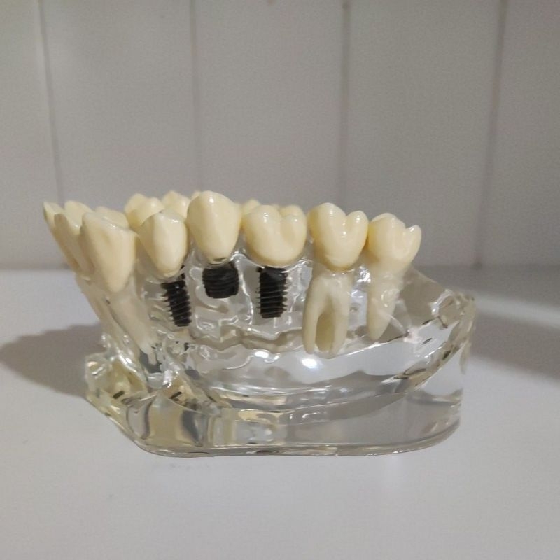 Study model implant upper ( DURADENT )