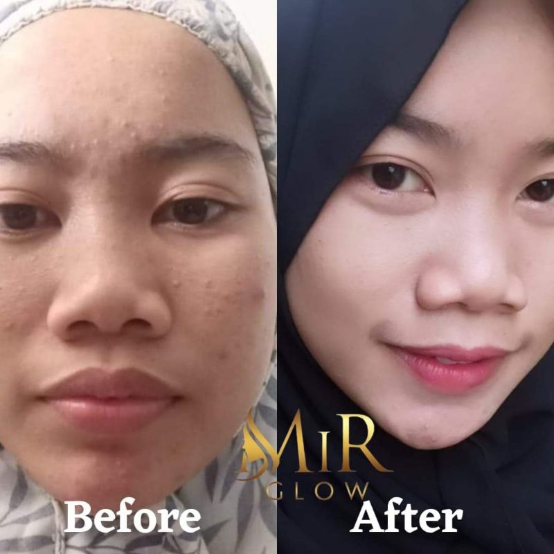 acne boster mirglow