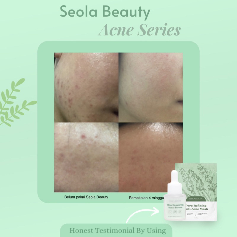 Pore Refining Anti Acne Mask