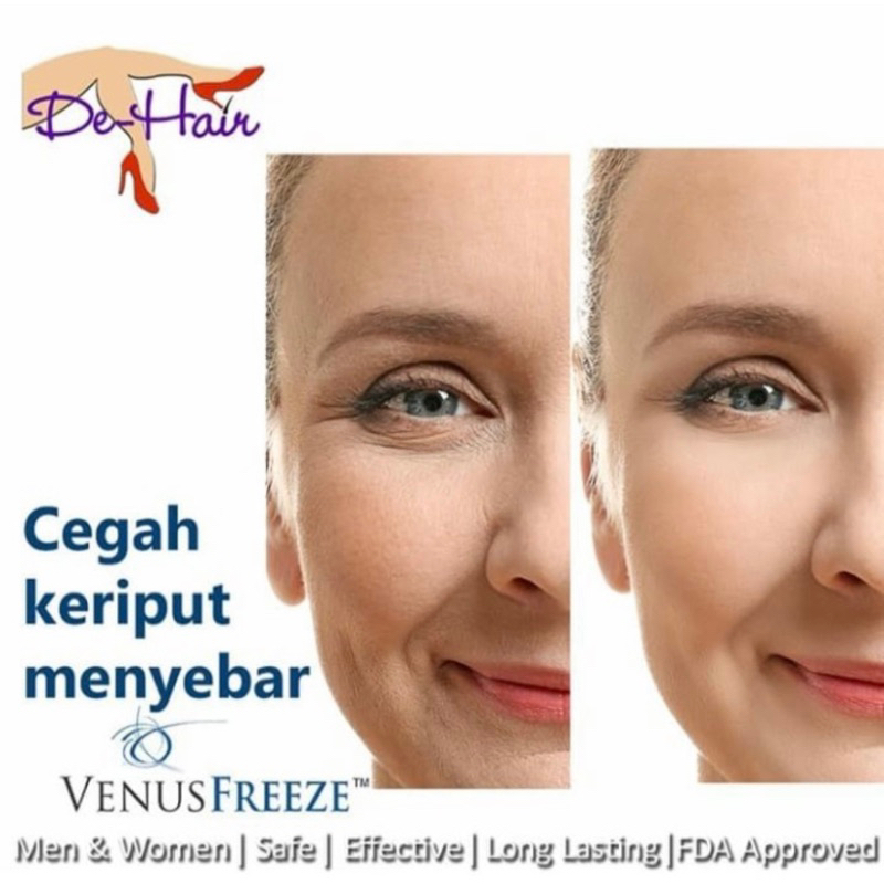 Venus Freeze Full Face 6X