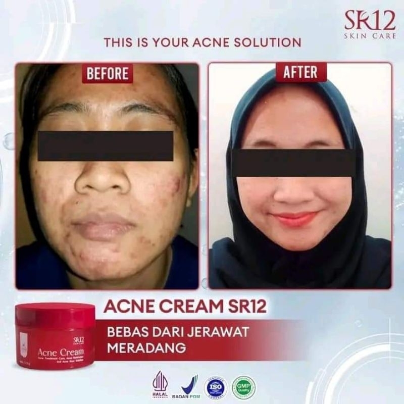Acne cream SR12