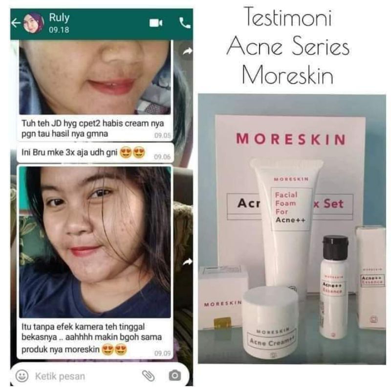 Moreskin Acne Series