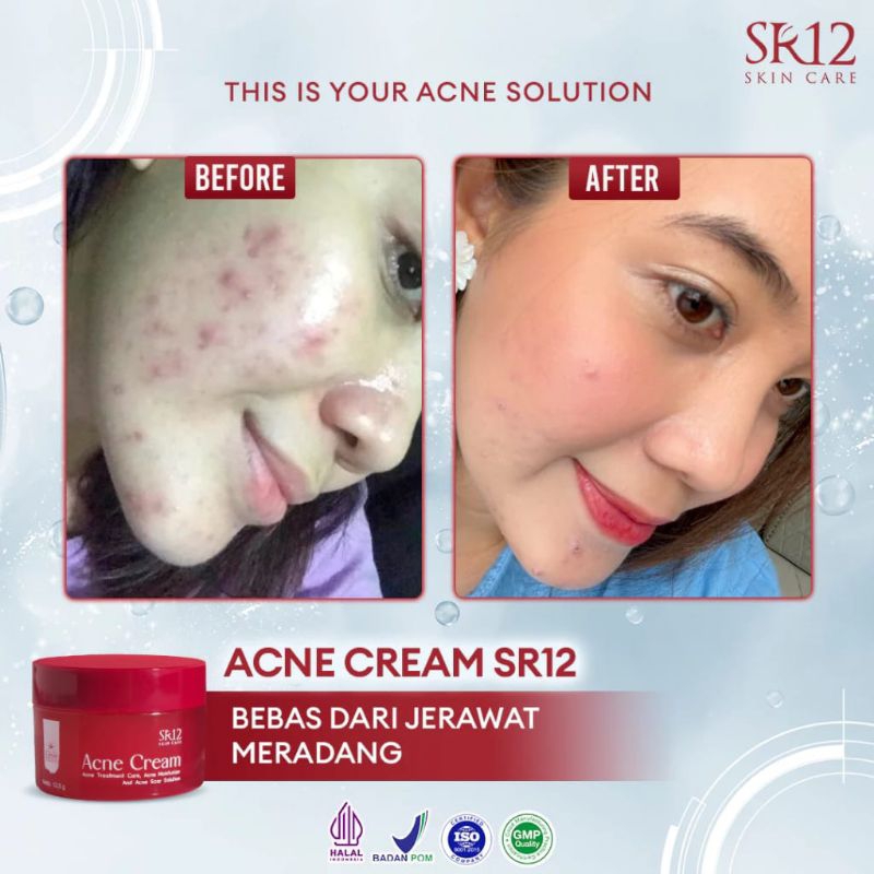 Acne Cream SR12