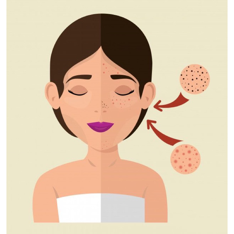 Acne Day Series
