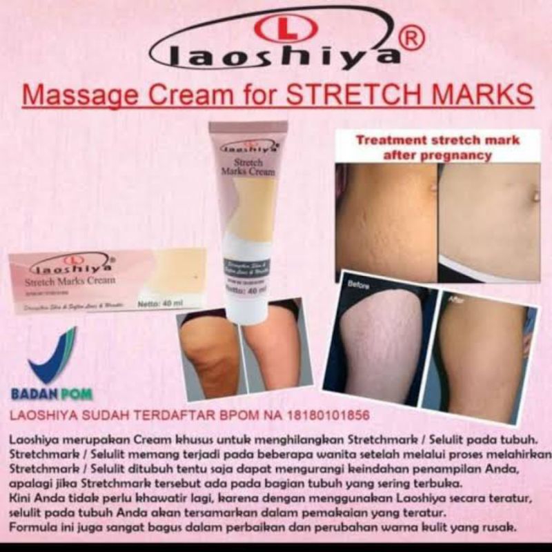 LAOSHIYA PENGHILANG STRETCH MARKS