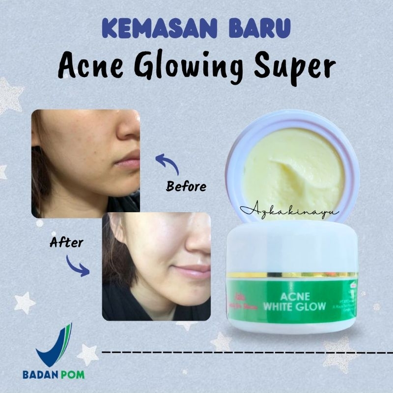 (BISA COD) CREAM MALAM ACNE GLOWING SUPER