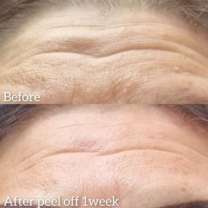 forehead plasma