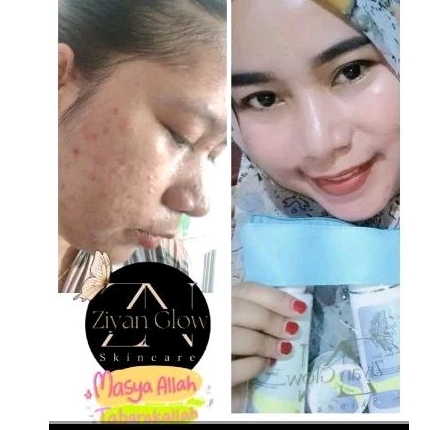 ziyan glow acne