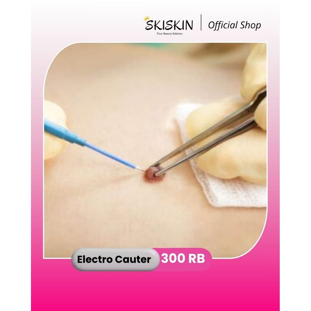 Electro Cauter Treatment