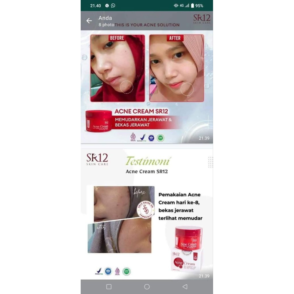Acne cream SR12