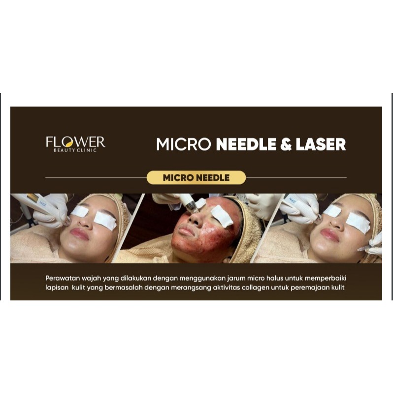 MICRO NEEDLE TREATMENT FLOWER