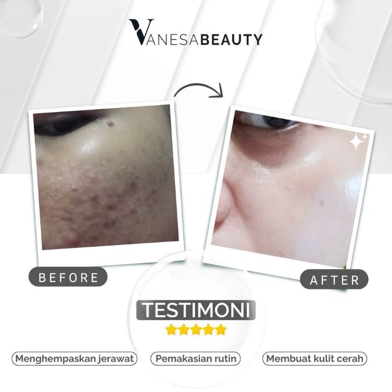 Vanesa paket acne /berjerawat