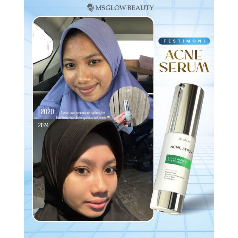 MS GLOW ACNE SERUM