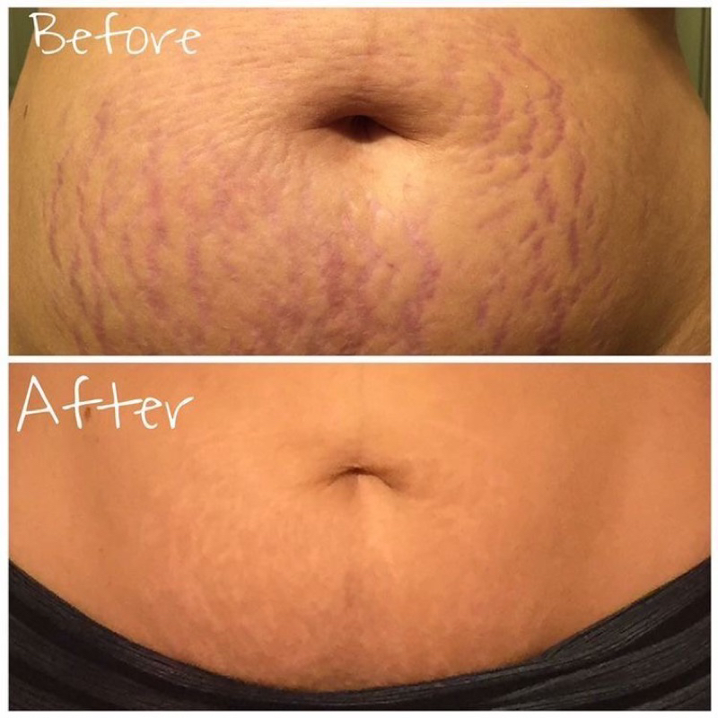 Cream Stretch Mark