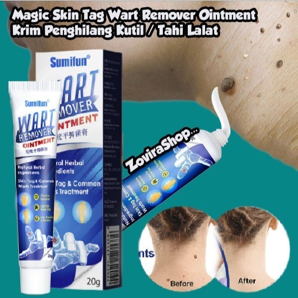 Authentic wart removal Oinment / wart Removal Gel