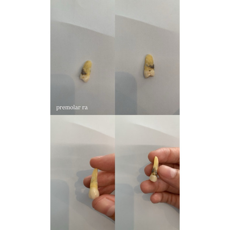 Pre Molar Rahang Atas