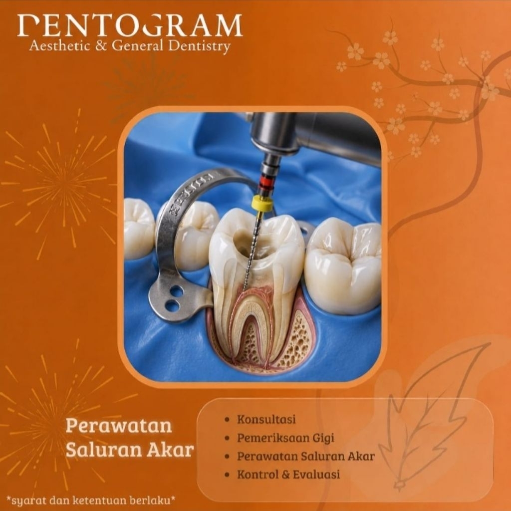 Perawatan Saluran Akar