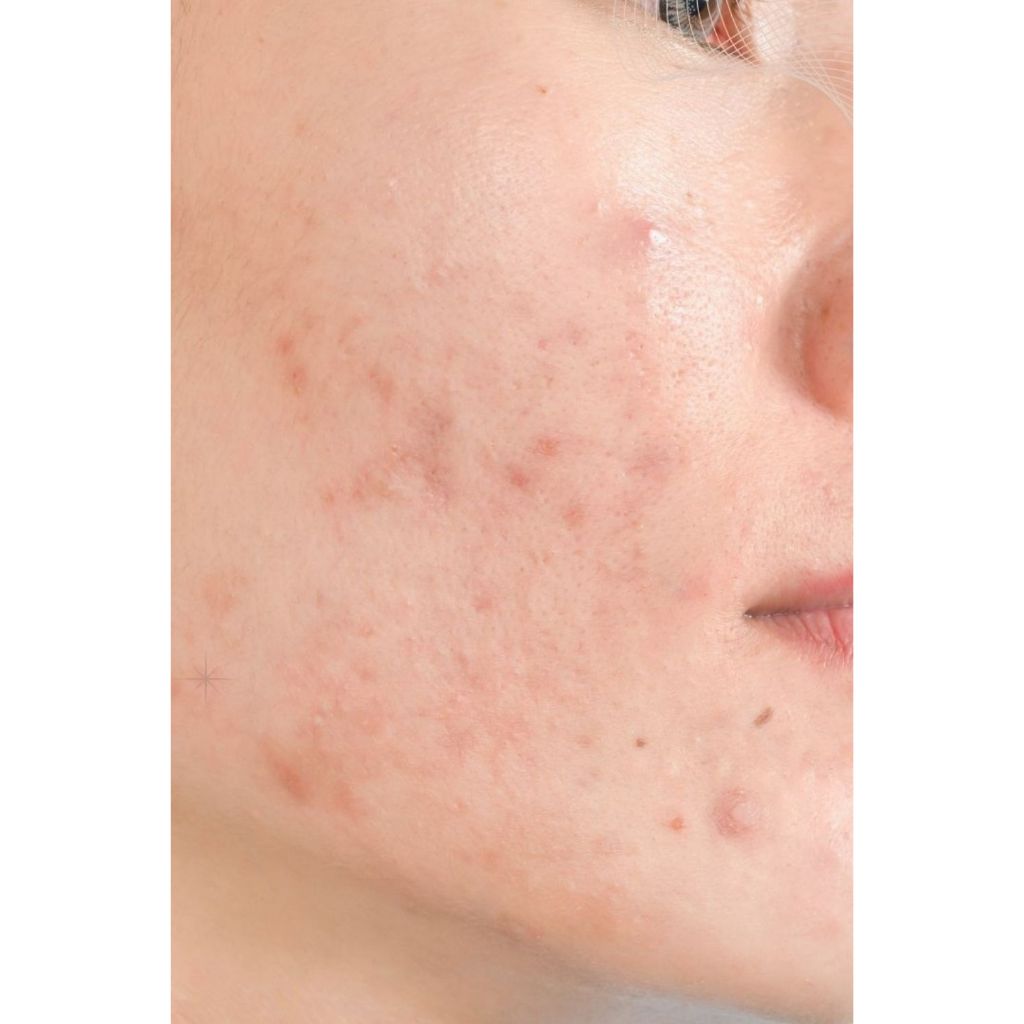 Facial Luxury Acne