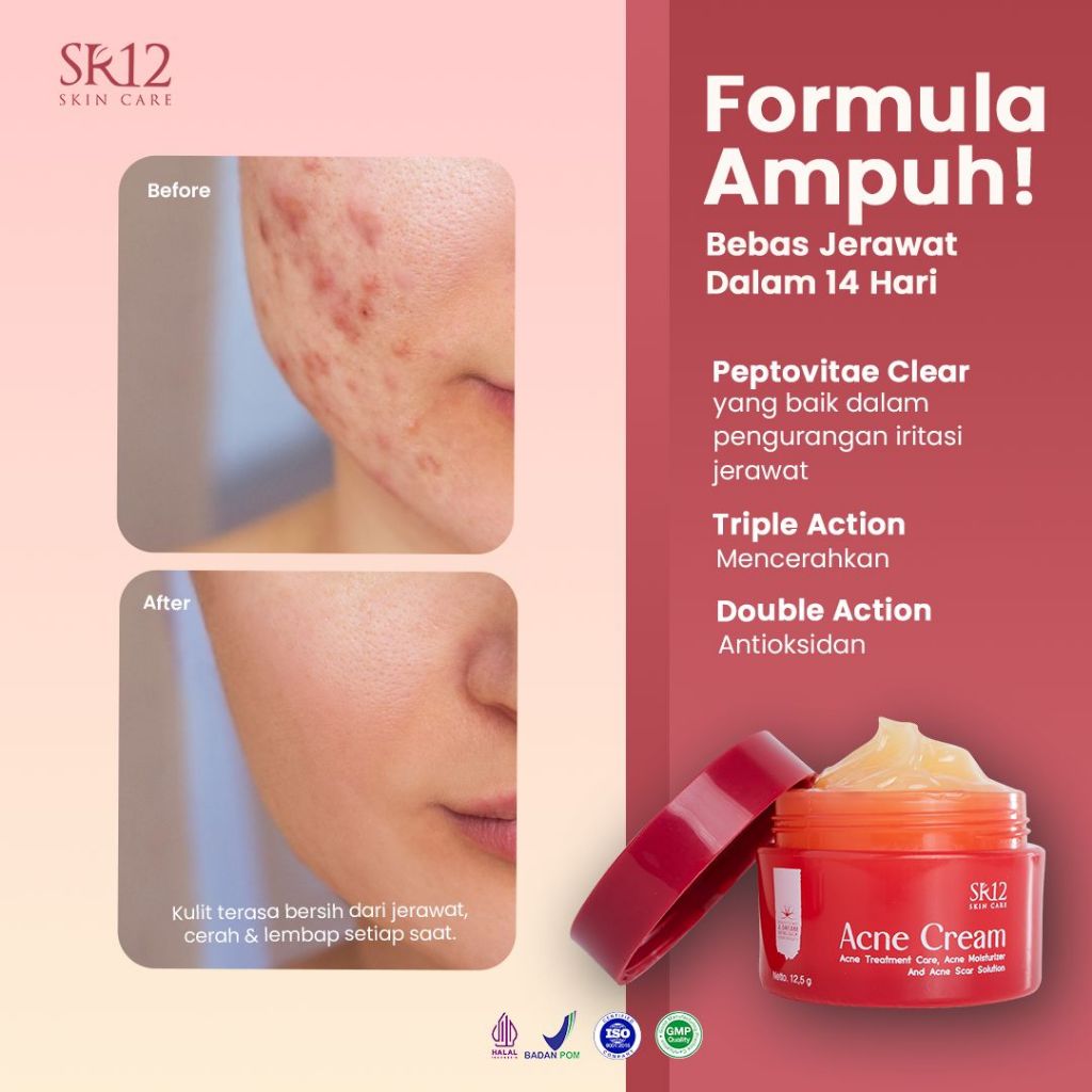 Cream Acne SR12