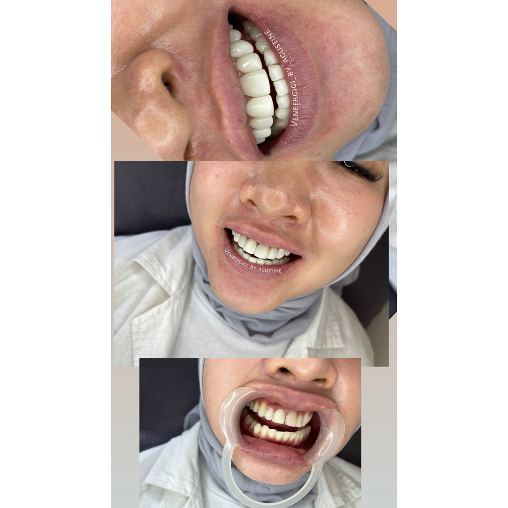 veneer japan