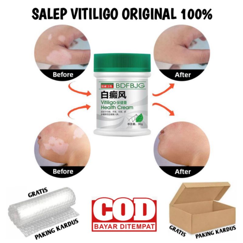 SALEP VITILIGO ORIGINAL 100%