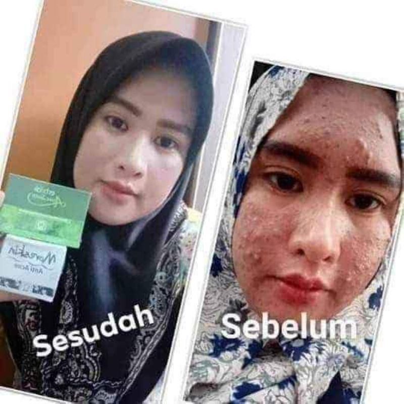obat jerawat