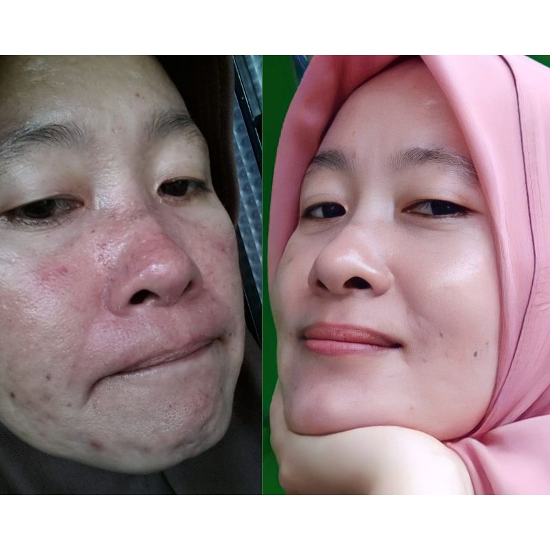 NIGHT CREAM ACNE