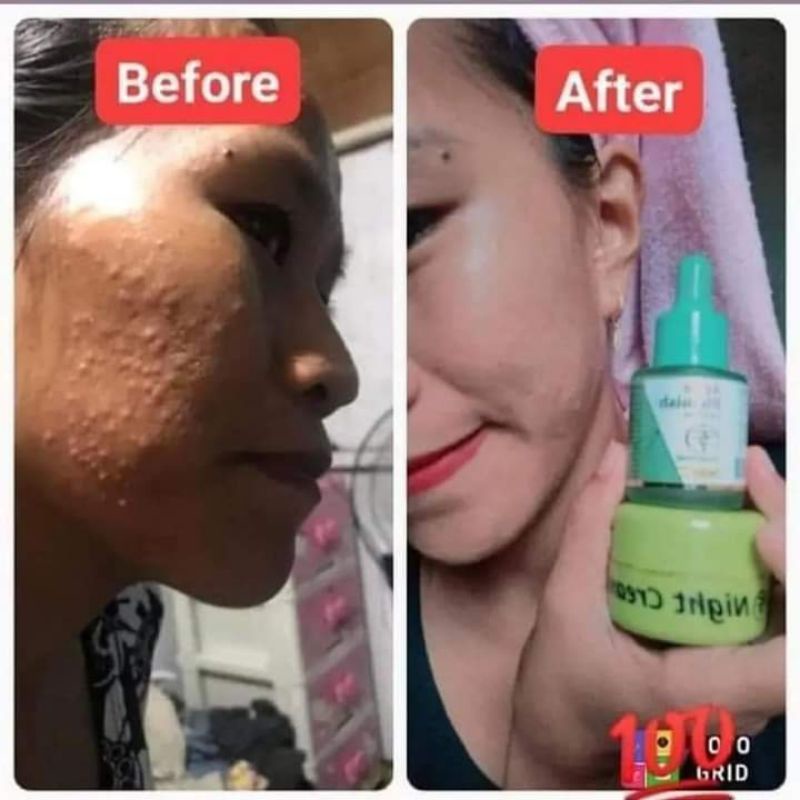 Serum Acne Blemish