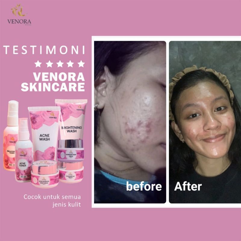 Venora paket acne