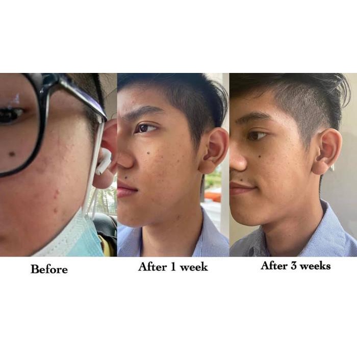 obat jerawat duraskin