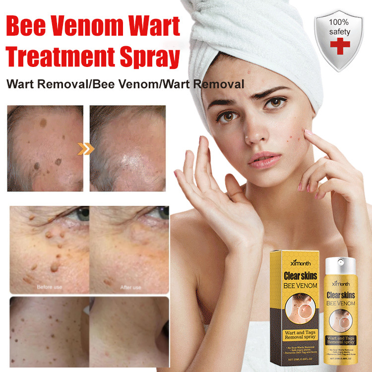 Wart Removal Spray with Bee Venom Ingredients