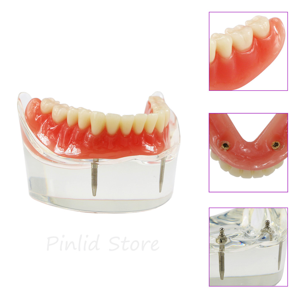 Dental Research Models Technician Practice Teaching Overdenture Demonstration Models 6002